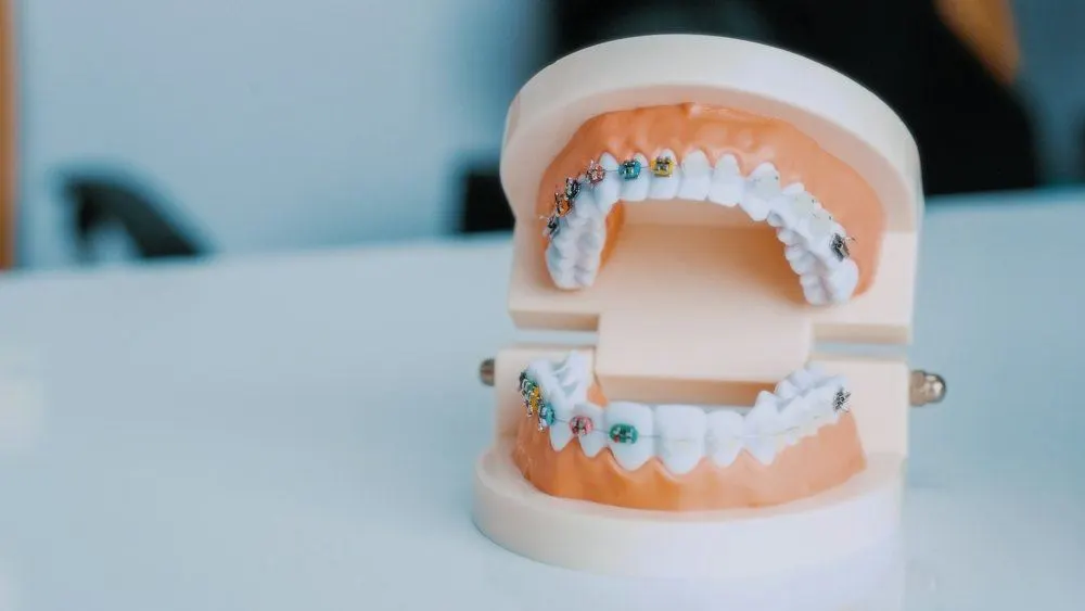 Modelo dental con brackets