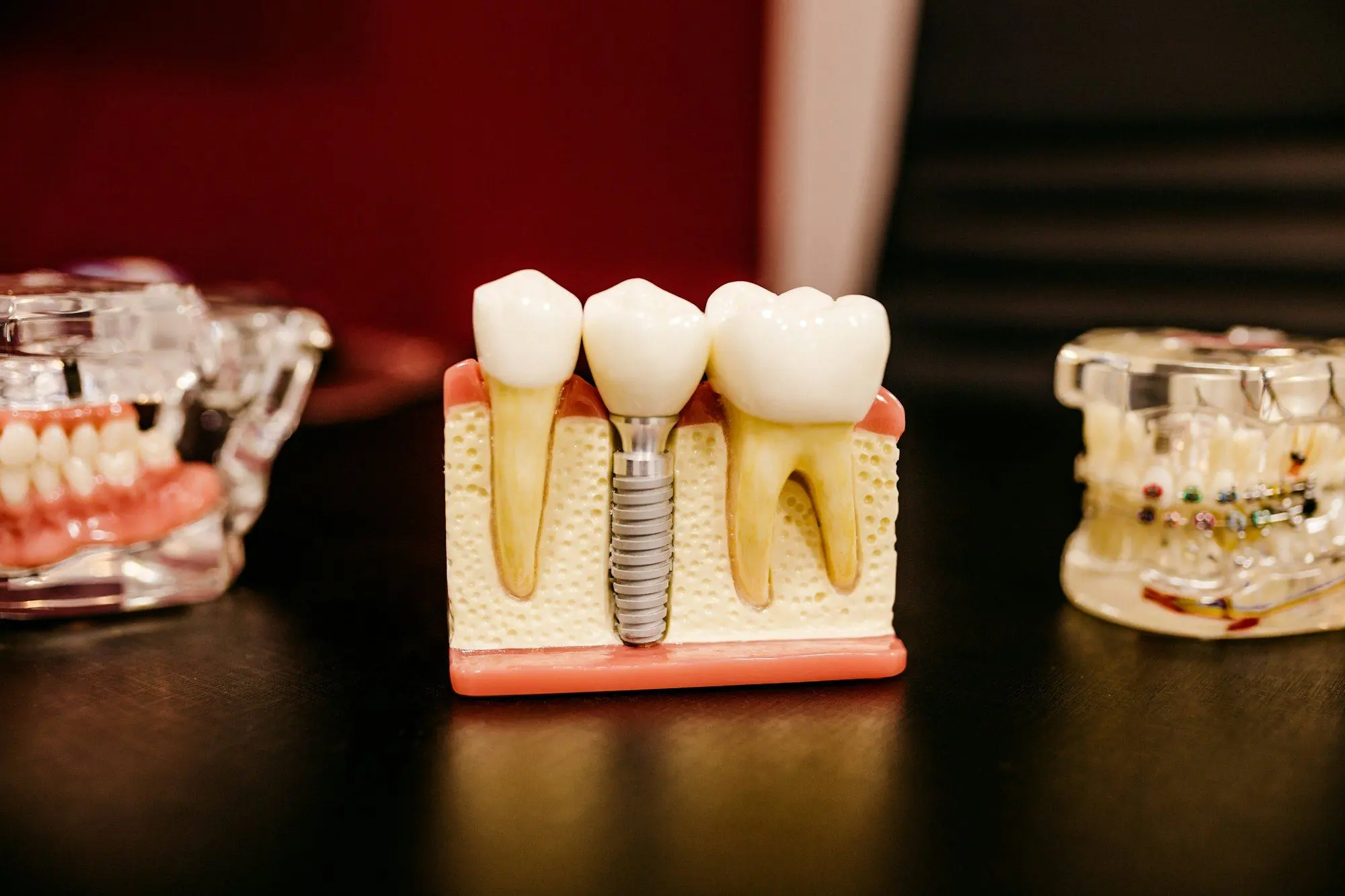 Modelo dental con implante y coronas